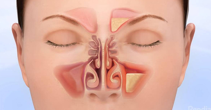 how to cure sinus permanently 